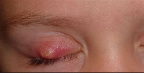 White Bump On Eyelid Small Hard Spots Inside Under