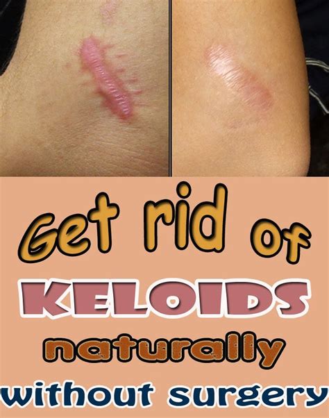 Pin On Get Rid Of Keloid Naturally