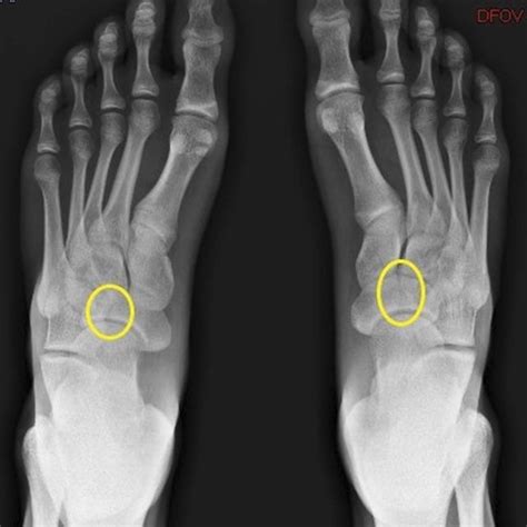 PDF Bilateral Navicular Stress Fractures With Nonunion In An