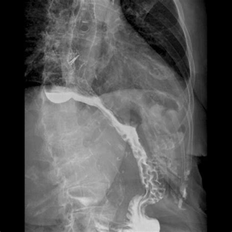 Pretreatment Esophagogram Demonstrating The Lower Esophageal