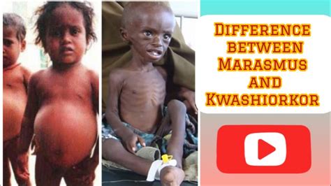 Marasmus And Kwashiorkor Difference Between Marasmus And Kwashiorkor