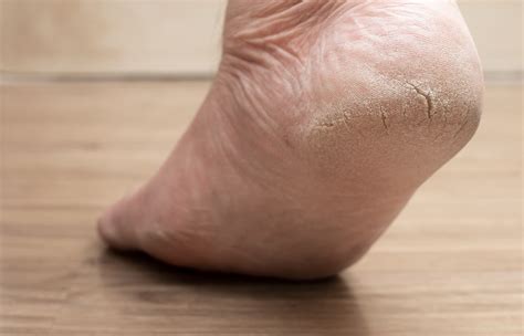 How To Fix Heel Fissures Canyon Oaks Foot And Ankle Fresno Podiatrist
