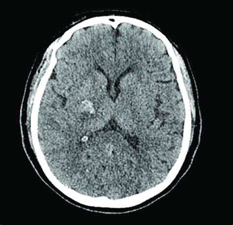 Non Contrast Brain Computed Tomography Showing Intracranial Hemorrhage
