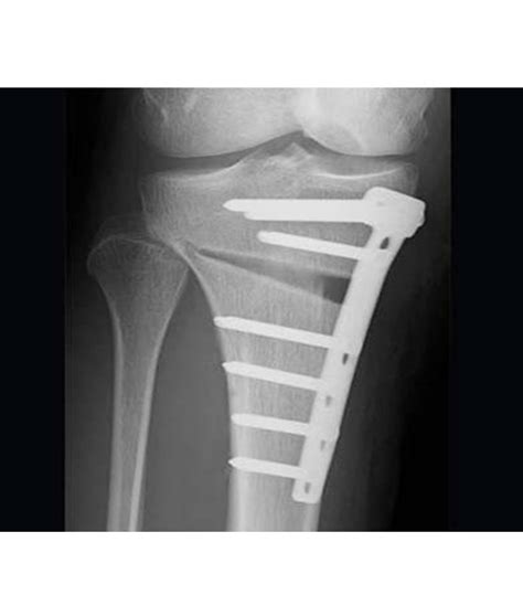 Debate High Tibial Osteotomy For Unicompartmental Arthritis