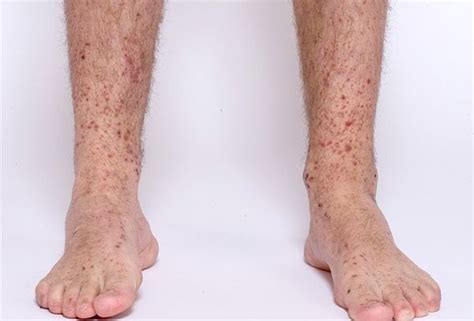 لکه های قرمز روی ساق پا نشانه چیست و چه علتی دارد؟ دکتر ریاحی