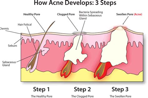 Amid victoria's worrying covid outbreak, perhaps the point of greatest concern is the fact the virus has again found its way into aged care. Understanding How Acne Forms and What Makes The Proactiv ...