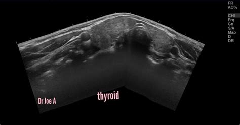 Ultrasound Imaging Diffuse Goiter Right Lobe Thyroid