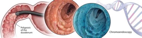 Signs and symptoms of colon cancer tend not to be specific. The impact of chromoendoscopy for surveillance of the ...