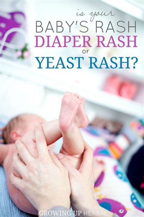 Is Your Baby S Rash Diaper Rash Or Yeast Rash GUH Baby Rash Baby Diaper Rash Diaper Rash