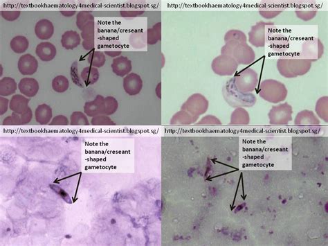 Haematology In A Nutshell Plasmodium Falciparum In Thick And Thin Films