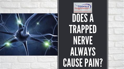 Does A Trapped Nerve Always Cause Pain Youtube