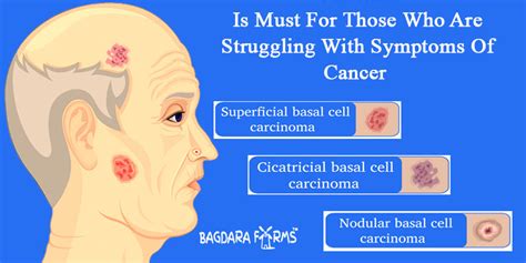 Basal Cell Carcinoma Enhancing Its Treatment With Curcumin