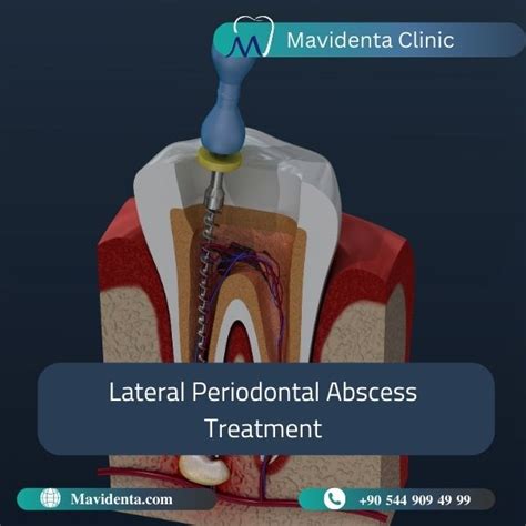Lateral Periodontal Abscess Treatment Symptoms Causes 2023
