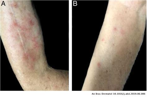 Case For Diagnosis Erythematous And Pruritic Papules On Forearms