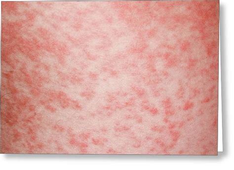 Amoxicillin Rash In Glandular Fever Photograph By Dr P Marazziscience