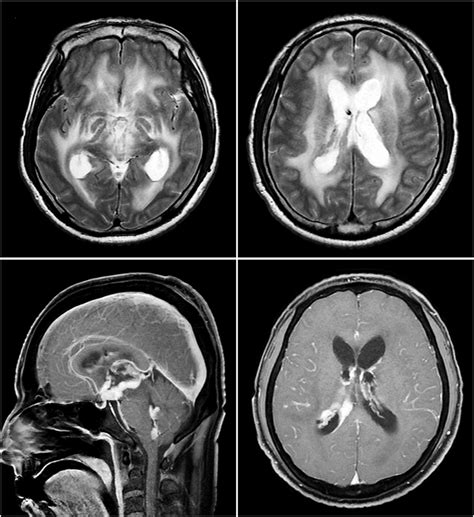 Brain Magnetic Resonance Imaging Mri After Ventricular Brain Biopsy
