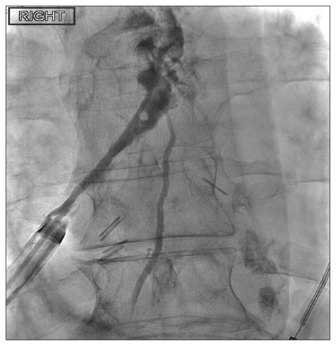 Thoracic Duct Embolization Via Chest Tube For A Patient With
