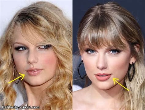 Taylor Swift Plastic Surgery Comparison Photos