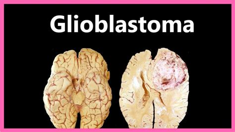 Glioblastoma Multiforme Symptoms Diagnosis And Treatment Youtube