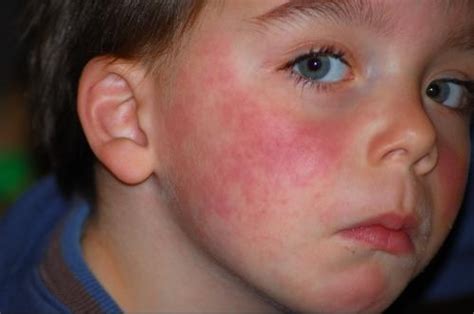 Mon Fils Allergique Aux Fraises Allergies Et Eczéma Forum Santé