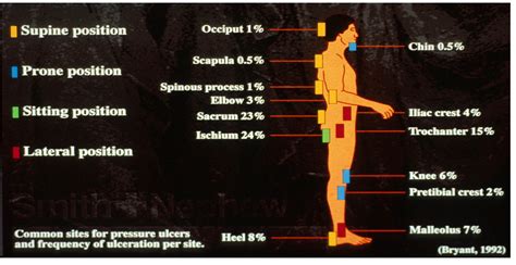 Common Sites Of Pressure Injury By Position And Frequency Supine