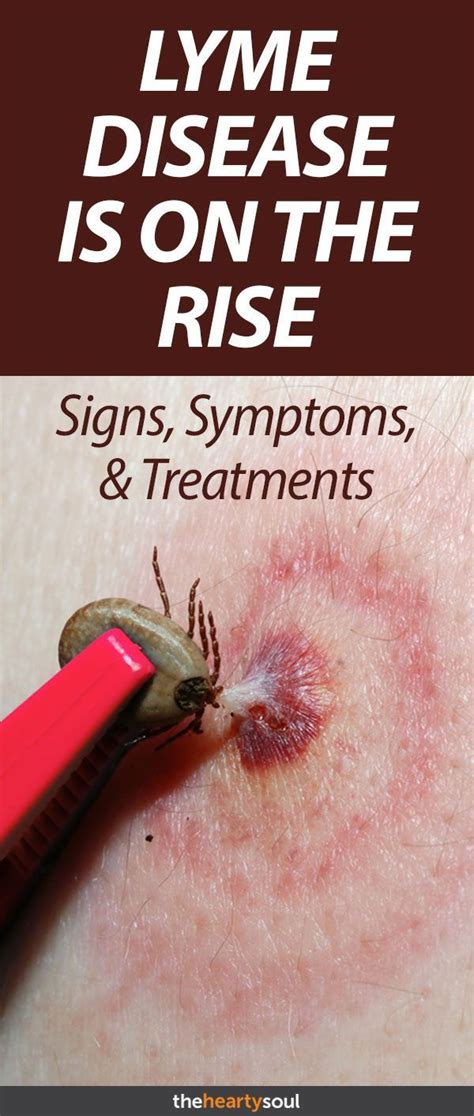 How To Recognize Infected Tick Bites And What You Should Do Immediately