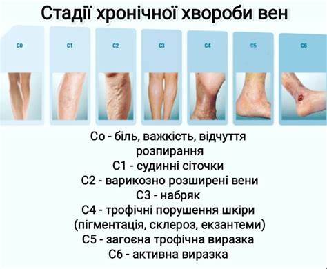 Варикоз лечить надо так – симптомы и причины расширения вен | РБК Украина Картинка - Варикоз лечить надо так – симптомы и причины расширения вен | РБК Украина