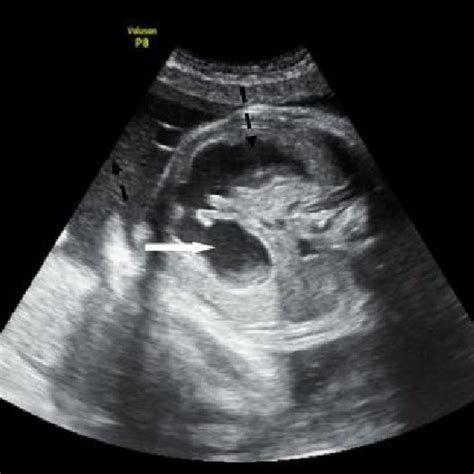 Prenatal B Mode Transverse Ultrasound Of The Fetal Abdomen Showing Two Download Scientific