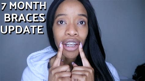 7 Month Braces Update Adult Braces Youtube