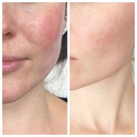 Pin By Amanda Amundson On Skin Care Laser Treatment Rosacea Skin