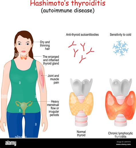 Hashimotos Thyroiditis Chronic Lymphocytic Thyroiditis Is An