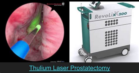 Thulium Laser Vapoenucleation Of The Prostate Thulep Thulium Laser Prostatectomy
