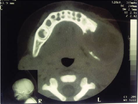 An Axial Ct Showing A Soft Tissue Mass On The Left Side With Mandibular