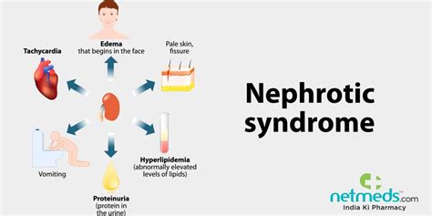 Nephrotic Syndrome Causes Symptoms And Treatment