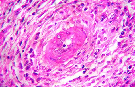 Aggressive Eosinophilic Granulomatosis With Polyangiitis And Transverse