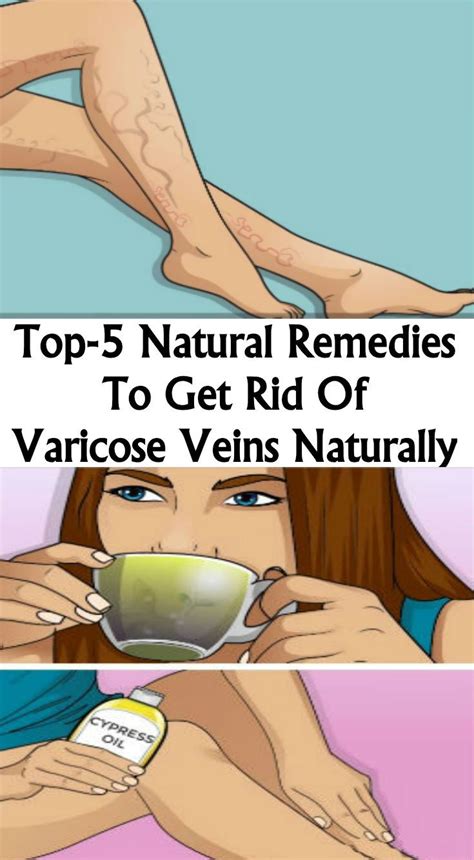 Top 5 Natural Remedies To Get Rid Of Varicose Veins Naturally