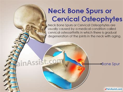 17 Best images about Bone Spurs In The Neck... on ...