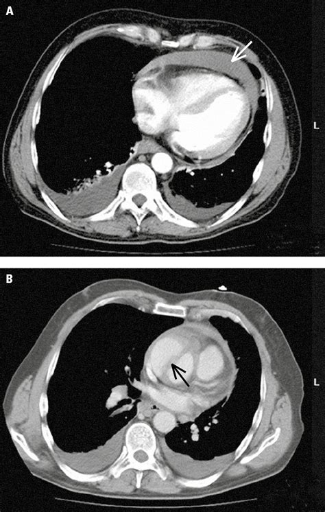 Figure 0317563 Multislice Computed Tomography Ct In A Patient With