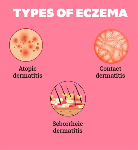All You Need To Know About Eczema On Face Be Beautiful India