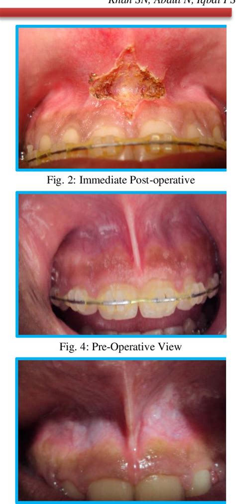 Figure 1 From Maxillary Labial Frenectomy Using Diode Laser Report Of Two Cases Semantic Scholar