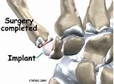Photos of Thumb Arthroplasty Recovery