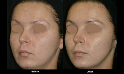 Forever Young Bbl Ipl Photofacial Before And After Med