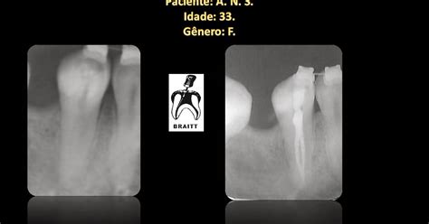 Endodontia Dr Henrique Braitt Tratamento endodôntico de um pré molar atípico