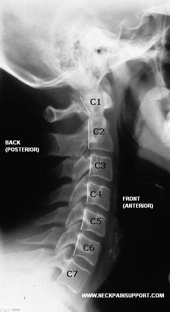 The Normal Cervical Curve In The Neck Neck Pain Support Blog