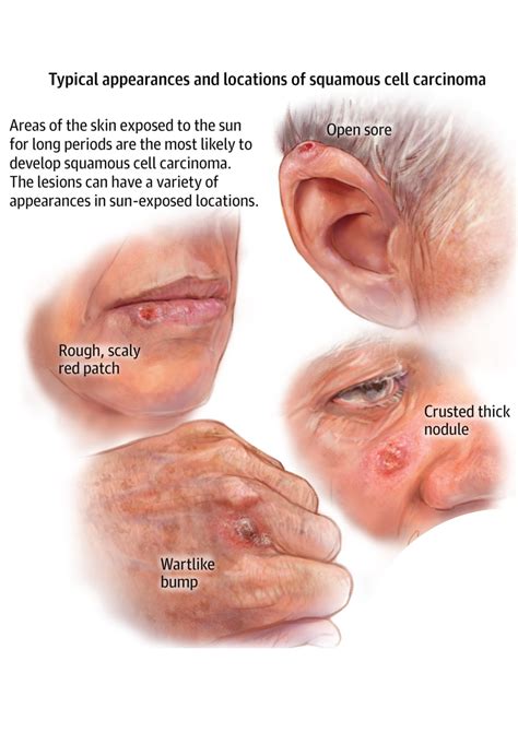 Skin Cancer Symptoms Five Warning Signs Of A Basal Cell Carcinoma Hot My Xxx Hot Girl