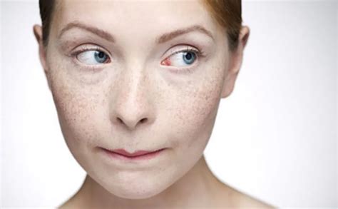 Sun Spots Vs Freckles Difference And How To Treat The Smart Health Center