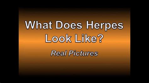 early signs of genital herpes pictures youtube