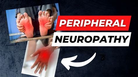What Is Peripheral Neuropathy What Can Be Done About It Youtube