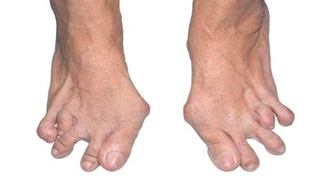 Rheumatoid Arthritis Feet Early Signs