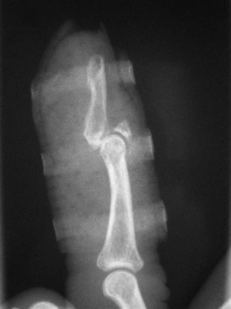 Intra Articular Fracture Of The Distal Phalanx Due To Extensor Tendon